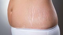Abdomen - Estrías