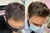 TRATAMENTO PARA ALOPECIA CAPILAR