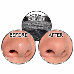 Imagens mostrando os resultados de uma máscara de limpeza facial para remoção de cravos e espinhas, com comparação antes e depois.