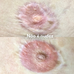 CURSO TATUAGEM PARAMÉDICA “MÉTODO PERFECT SKIN"