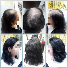 Próteses de Cabelo Natural Real ( Feita sob Medidas) com orçamento somente na loja