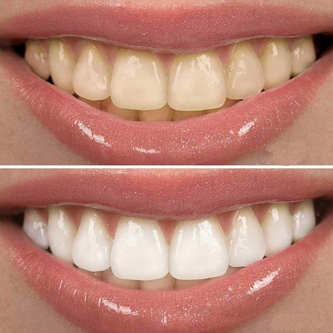 Clareador Dental Sefudun V34