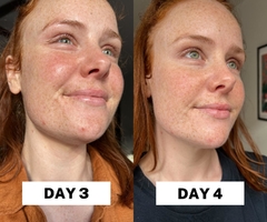 Salicylic Acid 2% Solution - comprar online