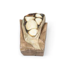 Modelo 3D de Colelitíase (cálculos biliares)
