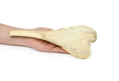 Modelo 3D de Osteossarcoma do fêmur - loja online