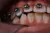 Cemento ortodontico Orthocem, jer. x 4g. FGM