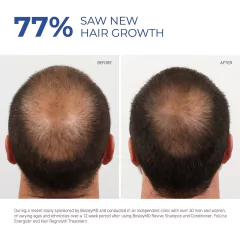 Produtos de crescimento rápido de cabelo natural prevenção de queda de cabelo - comprar online