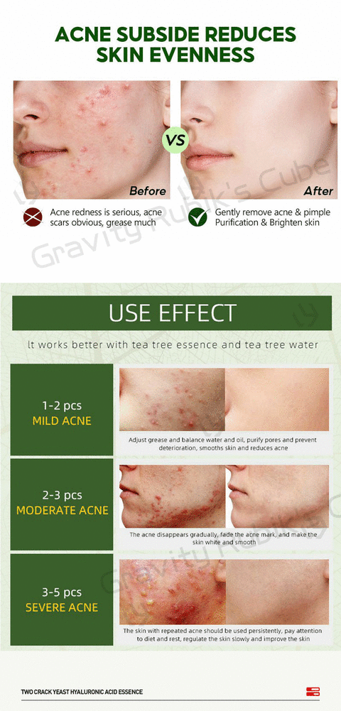 Creme para remoção de cicatrizes de acne Máscara para acne Gel para acne Creme espinhas