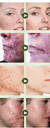 Creme para remoção de cicatrizes de acne Máscara para acne Gel para acne Creme espinhas - TopSales