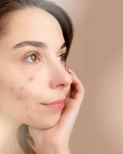 ACNE INTELIGENTE | Tratamento estratégico da acne