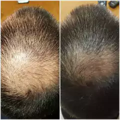 Mesoterapia en internet
