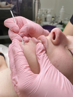 TRATAMIENTO PARA ACNE