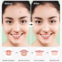 Imagen de Parches Facial De Acne Hidrocoloide Acido Salicilico Granos
