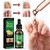 O Remédio De 7 Dias Para Eliminar Fungos Nas Unhas 30 ml