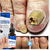 Gel da remoção do fungo do prego do dedo do pé da essência do reparo do pé - comprar online