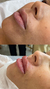 Preenchimento Labial com Ácido Hialurônico