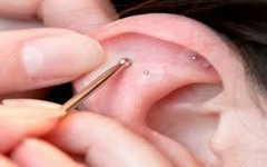 Auriculoterapia