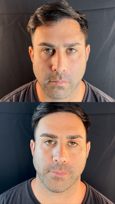 Relleno de Ojeras - comprar online