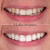 Blanqueador Dental Carbón Activado - tienda online