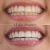 Imagen de Blanqueador Dental Carbón Activado
