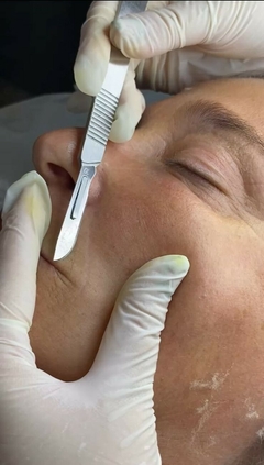 Peeling mecánico
