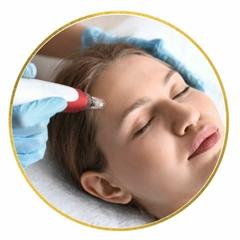 Dermapen Facial (Microneedling)