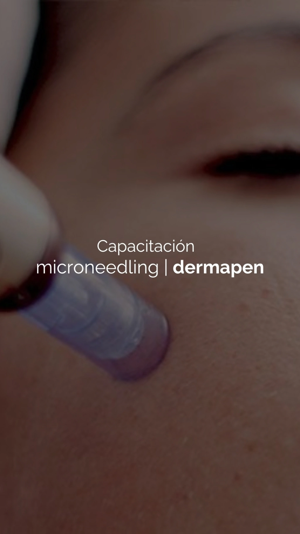 Microneedling