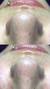 Higiene facial profunda + botas presoterapia - vm_skinlovers