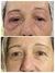 Fibroblastos Plasma Pen - Estetica Bella Love
