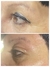 Imagen de Fibroblastos Plasma Pen