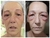 Fibroblastos Plasma Pen - tienda online