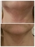 Fibroblastos Plasma Pen - Estetica Bella Love