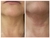 Fibroblastos Plasma Pen - tienda online
