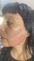 Fibroblastos Plasma Pen - Estetica Bella Love