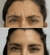Botox - comprar online