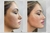 Armonización Facial en internet