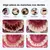 Scaler dental sônica elétrica na remoção de manchas - loja online
