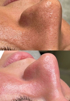 Limpieza facial con extracción