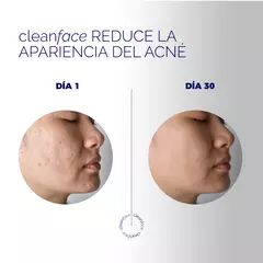 Limpiador para Acné 125ml - CLEAN FACE