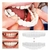Carillas dentales