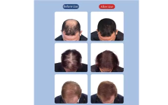 Gorra Luz Led De Cuidado Capilar- Estimula El Crecimiento - IMPORTLANDIA