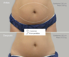 PACK CRIOLIPO FAST 360 4 SESIONES - EGLAM