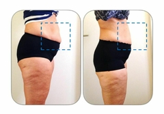 PACK CRIOLIPO FAST 360 4 SESIONES - tienda online