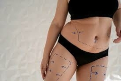 CRIOLIPOLISIS 1 SESION ( 1 ZONA )