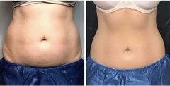 PACK CRIOLIPO FAST 360 4 SESIONES