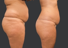 CRIOLIPOLISIS 1 SESION ( 1 ZONA ) - EGLAM