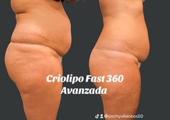 CRIOLIPO FAST 360 PLAN FULL LIPO SIN CIRUGIA / NUTRICION / ENTRENADOR PERSONAL - comprar online