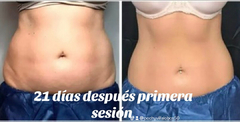 CRIOLIPO FAST 360 PLAN FULL LIPO SIN CIRUGIA / NUTRICION / ENTRENADOR PERSONAL - EGLAM