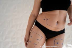 Imagen de CRIOLIPO FAST 360 PLAN FULL LIPO SIN CIRUGIA / NUTRICION / ENTRENADOR PERSONAL