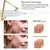 CANETA LASER DE PLASMA REMOVEDORA DE VERRUGAS, MANCHAS DE PELE COMO PAPILOMAS, SARDAS, MANCHAS ESCURAS, KIT CAUTERIZADOR USB - loja online